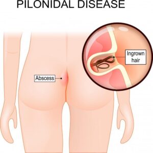 Pilonidal Cyst Treatment in Tellapur