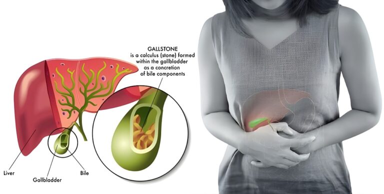 Gallstone surgery cost in Tellapur