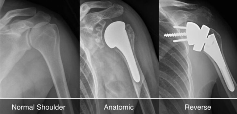Shoulder Replacement Hospital Treatment in Tellapur