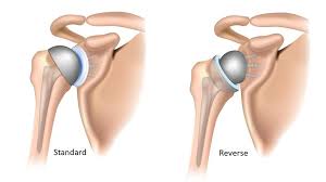 Shoulder Replacement Hospital Treatment in Tellapur