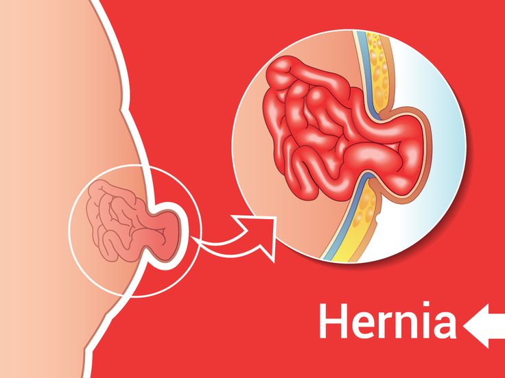 Hernia Treatment in Tellapur