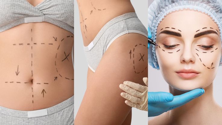 Liposuction Surgery Treatment cost in Tellapur