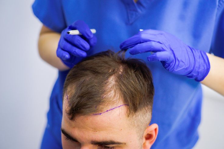Hair Transplant Treatment cost in Tellapur