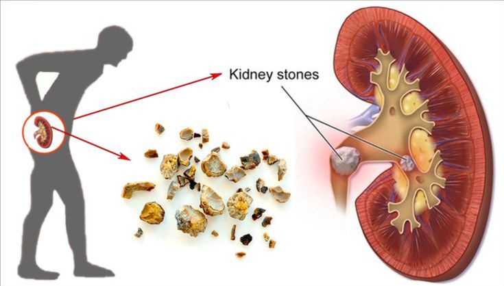 Kidney Stones Treatment in Tellapur