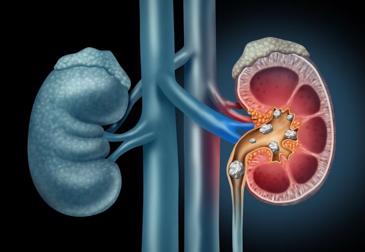 Kidney Stones Treatment in Tellapur