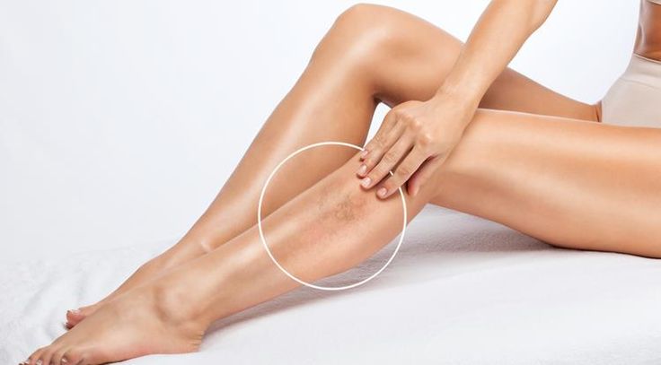 Varicose veins Treatment in Tellapur