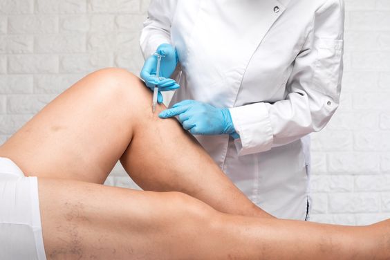 Varicose veins Treatment in Tellapur