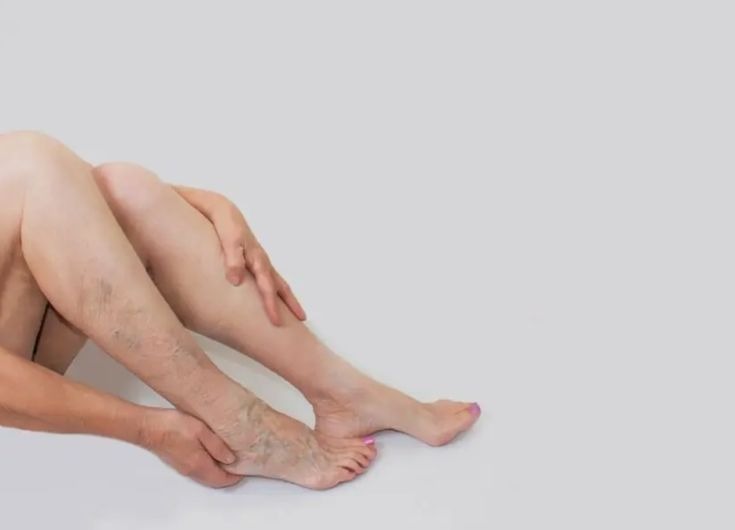 Varicose veins Treatment in Tellapur