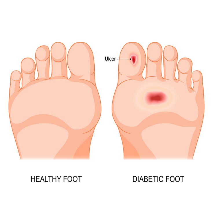 Diabetic Foot Ulcer treatment in Tellapur