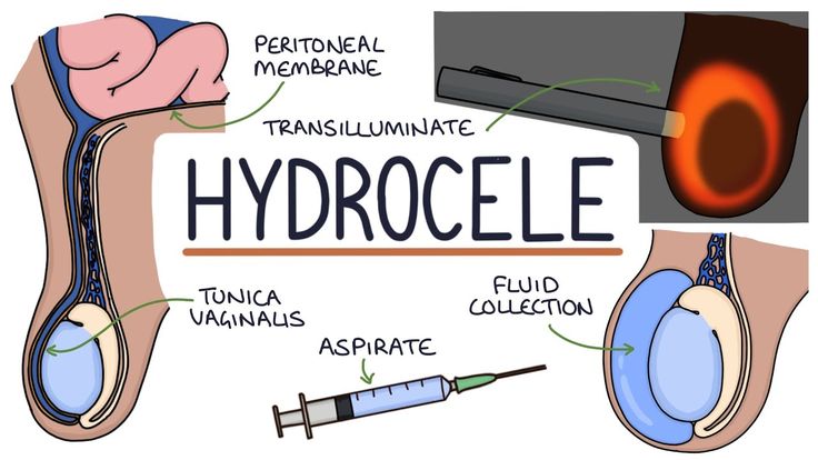 Hydrocele Treatment Cost in Tellapur